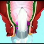 Cisti alle Dita delle Mani: Cause, Sintomi e Trattamenti