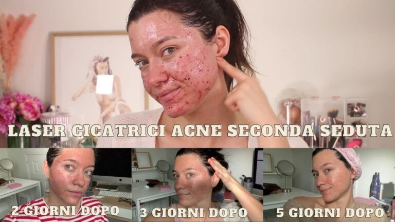 Risultati del Laser sulle Cicatrici: Prima e Dopo
