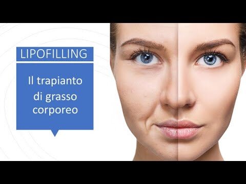 Lipofilling Viso: Esperienze Negativa e Riflessioni