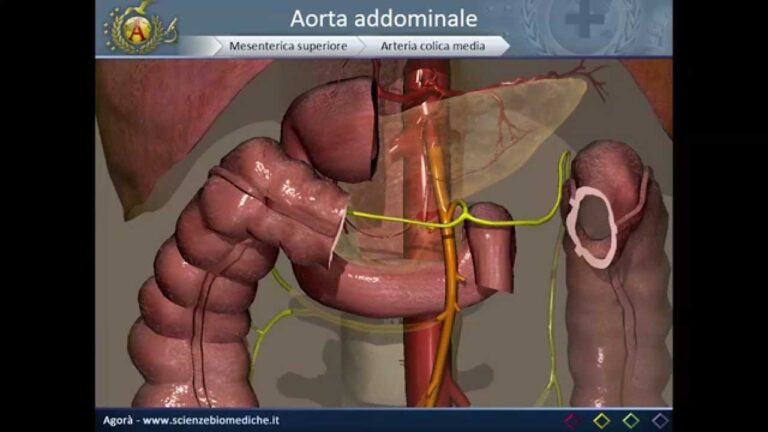 Ateromasia Parietale: Comprendere e Gestire Questa Condizione