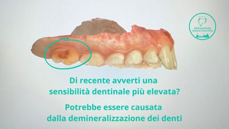 Demineralizzazione Dentale: Cause, Conseguenze e Rimedi